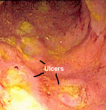 Picture of Crohn's disease / colitis of the bowel walls
